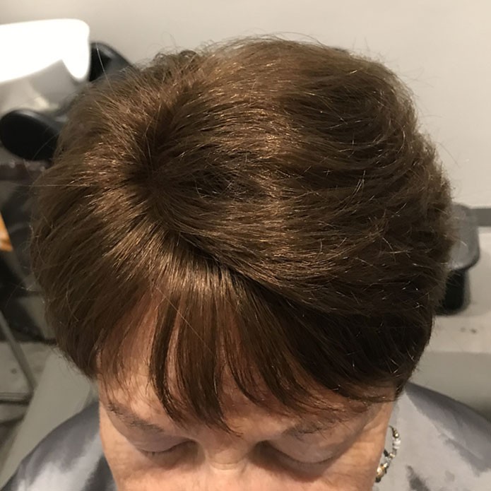kms-hair-replacement-patient-3-after